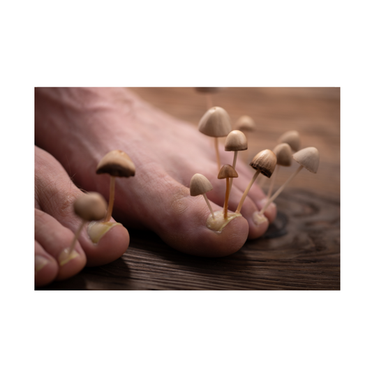 Is lasertherapie voor schimmelnagels een oplossing? - LSK